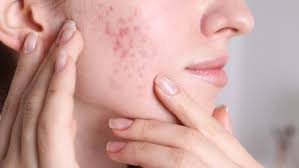 Fungal Acne: The Hidden Skin Concern and How K-Beauty Solves It