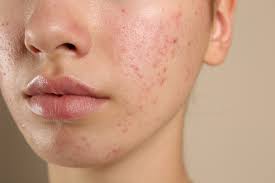 Hormonal Acne and the Korean Skincare Cycle Method