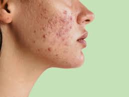 Best Korean Serum for Hormonal Acne – K-Beauty Skincare for Chin Breakouts, Blemishes & Sensitive Skin